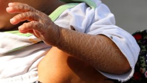 Balık pulu hastası kardeşler yardım bekliyor