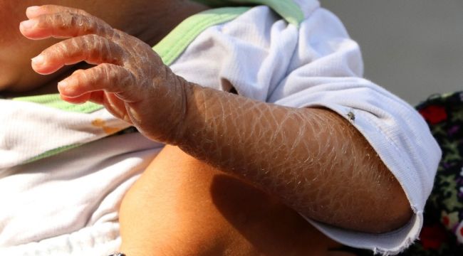 Balık pulu hastası kardeşler yardım bekliyor