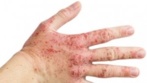 Sizde de bu belirtiler varsa, Rozasea olabilirsiniz