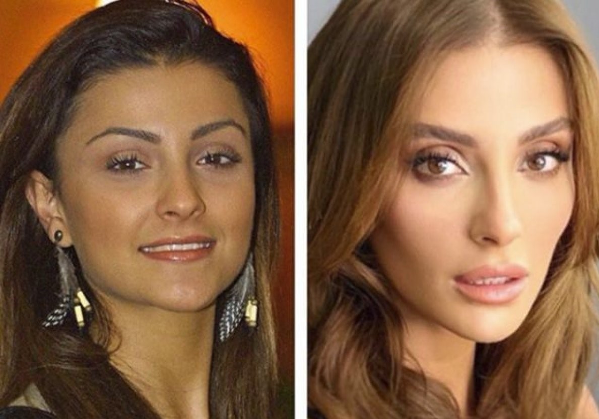 Evet, estetik yaptırdım