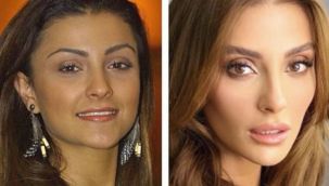 Evet, estetik yaptırdım