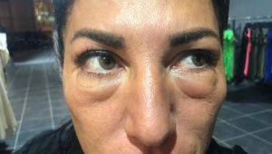 Gözaltı ışık dolgusu yaptırdı, hayatı karardı