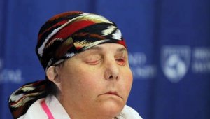 İki kez yüz nakli yapılan kadın, yeni yüzünü gösterdi