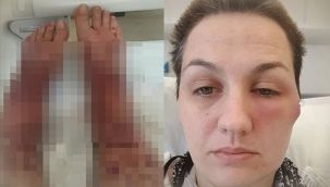 AstraZeneca aşısı bu hale getirdi!