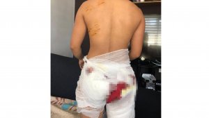 10 köpeğin saldırısına uğrayan kadın ağır yaralandı