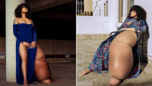 Hastalığı yüzünden tek bacağı 45 kilo!