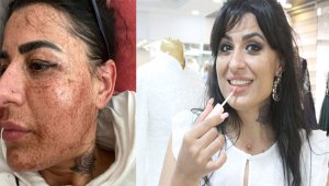 Cilt bakımı yaptırdı, eski yüzüne 8 ayda kavuşabildi