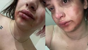 Erkek arkadaşı, tayt giydiği için bu hale getirdi