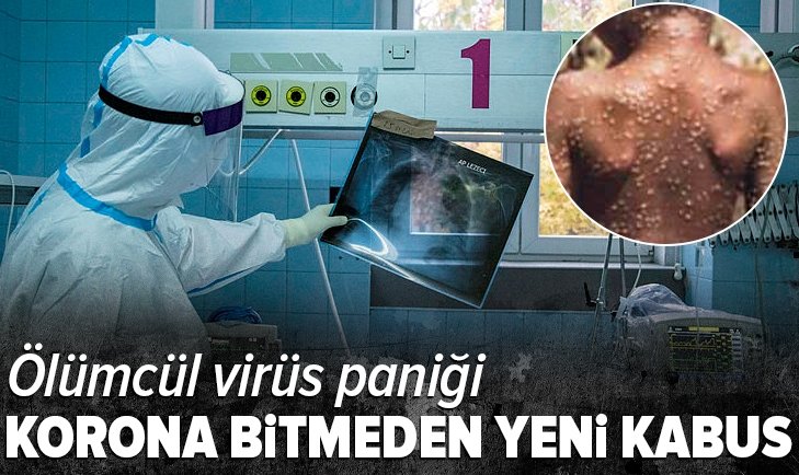 İki kişide "maymun çiçeği virüsü" görüldü