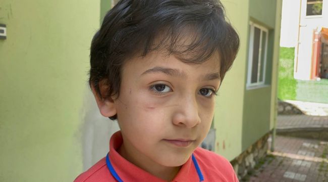 8 yaşındaki Mehmet'in yanağını başı boş sokak köpeği koparıyordu
