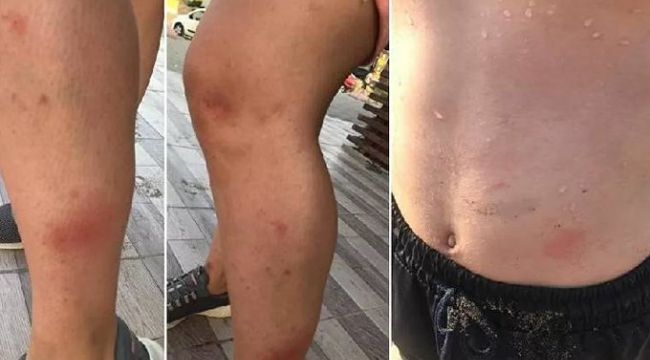 Denize giren kaşınarak çıktı