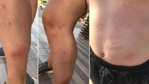 Denize giren kaşınarak çıktı