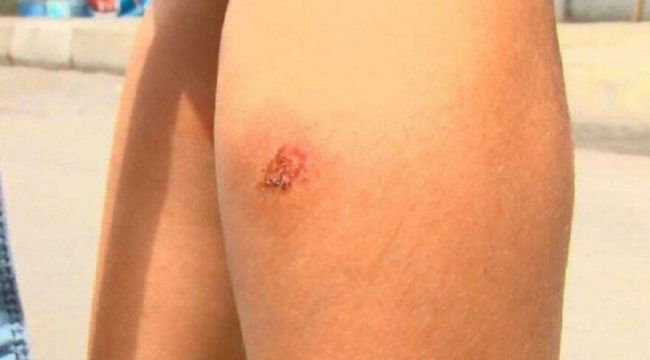 Isırılan 'yandım anam' diye veryansın edecek