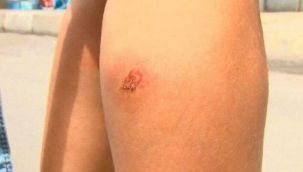 Isırılan 'yandım anam' diye veryansın edecek