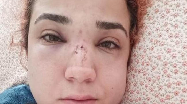 Kadın çalışanın burnunu kırdı 4,5 yıla kadar hapis isteniyor
