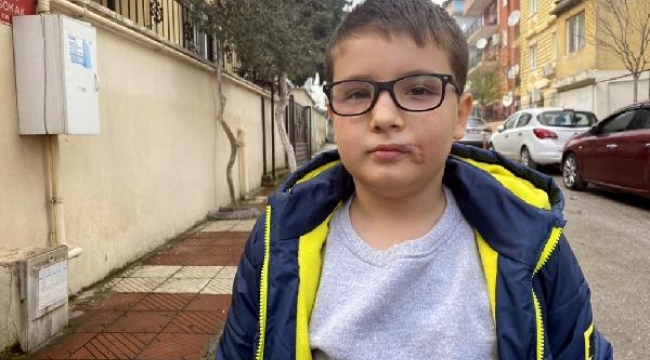 Köpek saldırısı sonrası yüzüne 60 dikiş atılan Mert, günler sonra sokağa çıktı