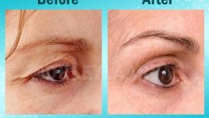 Düşük ve yorgun gözlere, göz kapağı estetiği ile son verin!