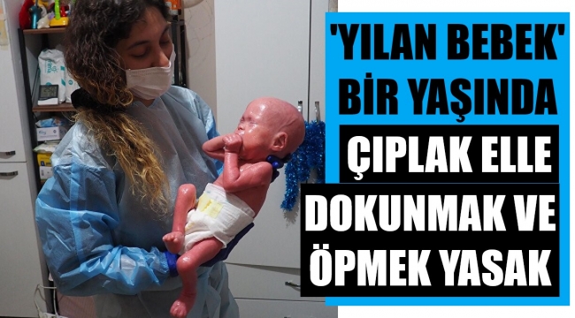 'Yılan bebek' Gökdeniz 1 yaşında