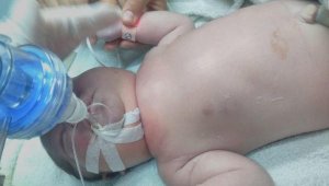 Doğumda bebeğin köprücük kemiği kırıldı