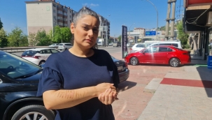 Epilasyon sonrası kolları yandı