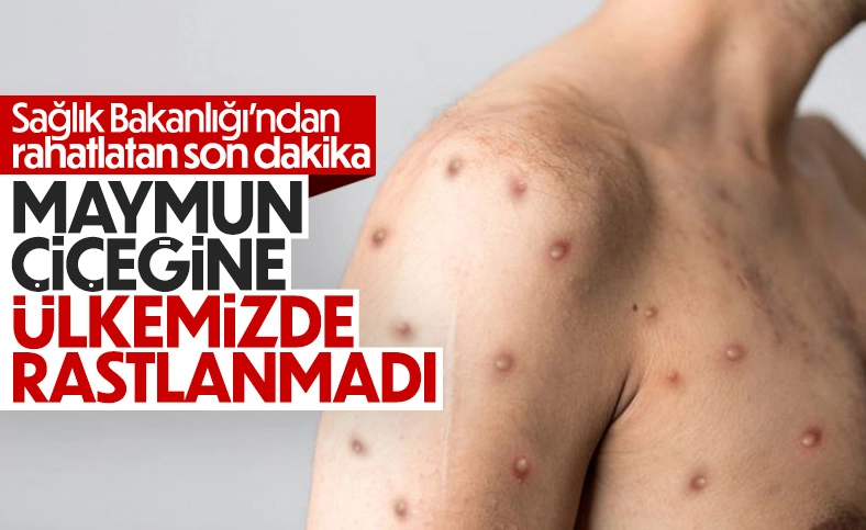 Sağlık Bakanlığı: Ülkemizde maymun çiçeği vakası görülmedi