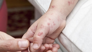 Türkiye'de ilk maymun çiçeği hastalığı tespit edildi