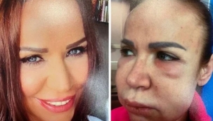 Estetik faciası: Dolgu için gitti tanınmaz hale geldi