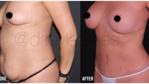 Karın germe ameliyatının iyileşme süreci zor mudur?