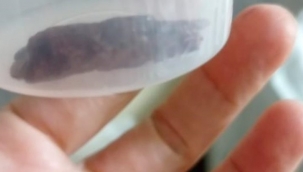 Hastanın elinde odun parçası unutuldu