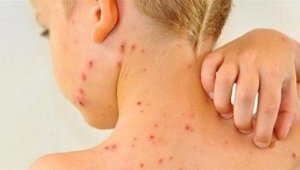 Kızamık vakalarına salgın demek yanlış olur